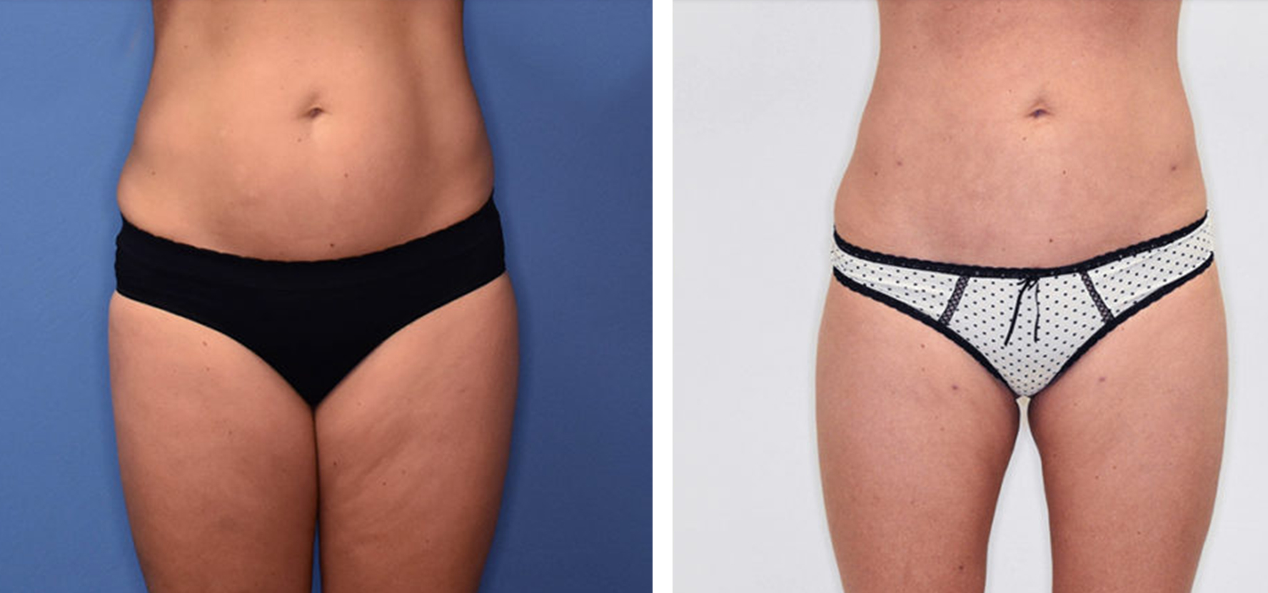 Belle_Medical-Before_After-Body_Sculpting-4-1024x640-1