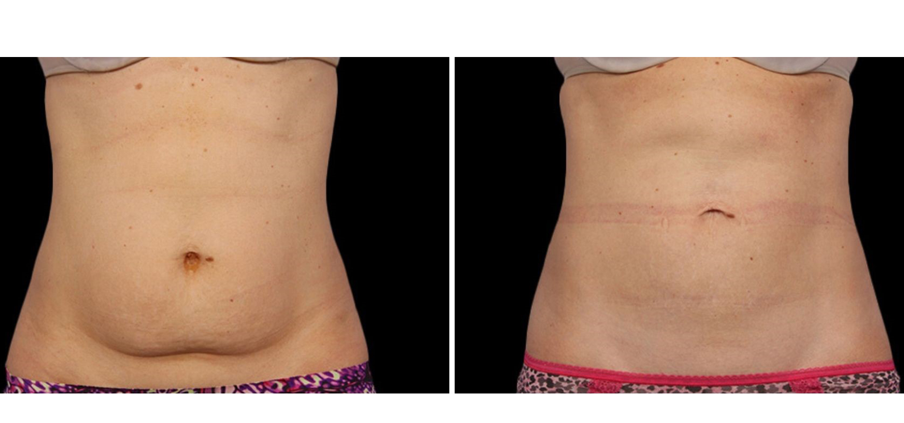 cooslculpting_before_and_after_lsinj